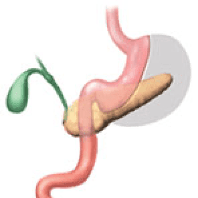 Sleeve Gastrectomy (Scarless)