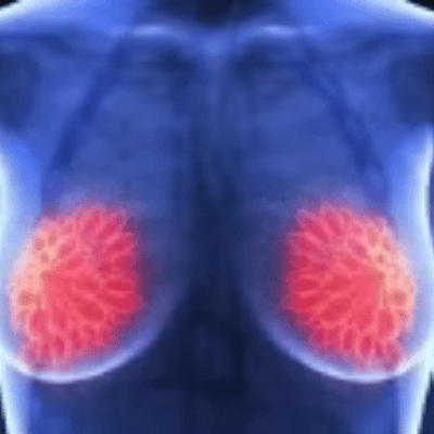 Breast Cancer